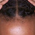 cornrows itching cornrows itching